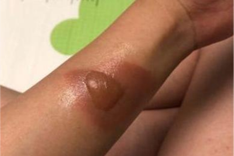 二度烫伤胳膊大水疱图 二度烫伤胳膊大水疱图