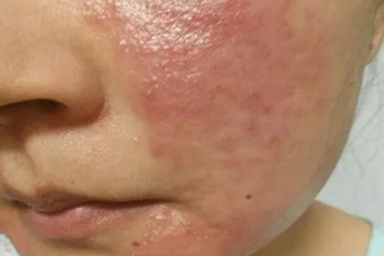 海鲜过敏面部全是红斑图