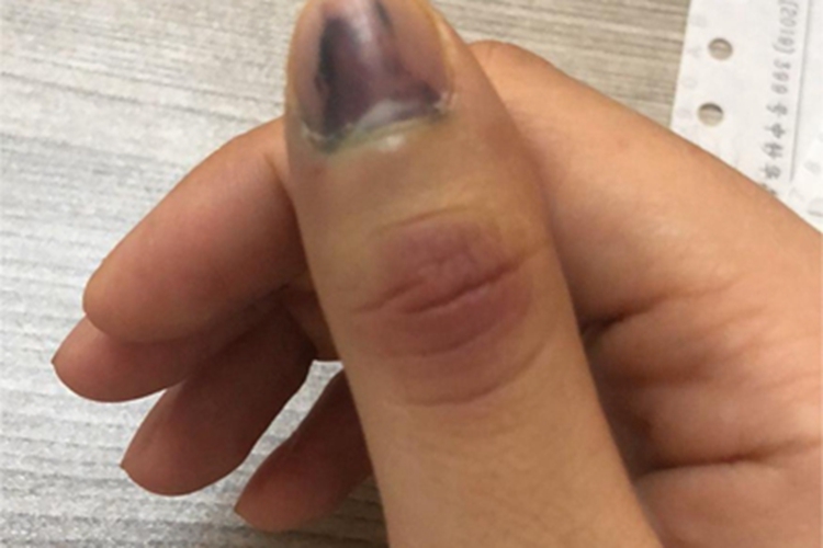 挫伤手指发红图