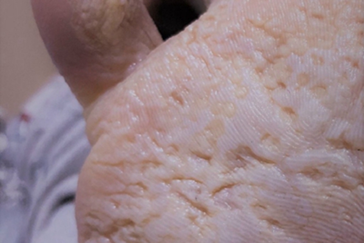 窝状角质松解症皮肤颜色变浅图 窝状角质松解症皮肤颜色变浅图