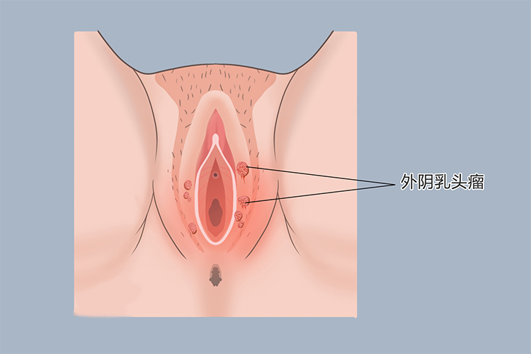 外阴肿瘤图