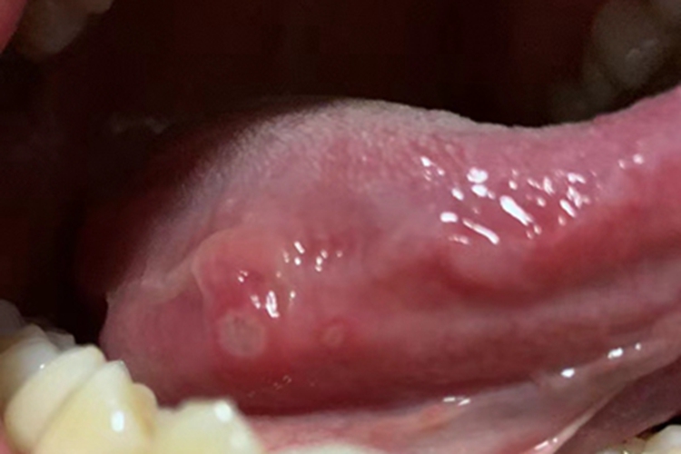 轻型阿弗他溃疡舌侧溃疡图 轻型阿弗他溃疡舌侧溃疡图