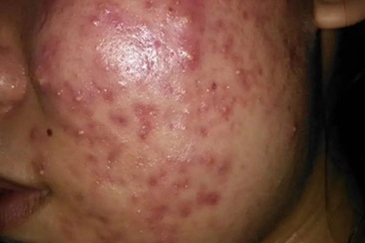 糖皮质激素依赖性皮炎面部丘疹图 糖皮质激素依赖性皮炎面部丘疹图