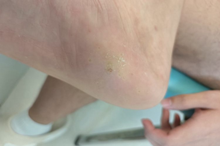 寻常疣脚底半透明斑块图 寻常疣脚底半透明斑块图