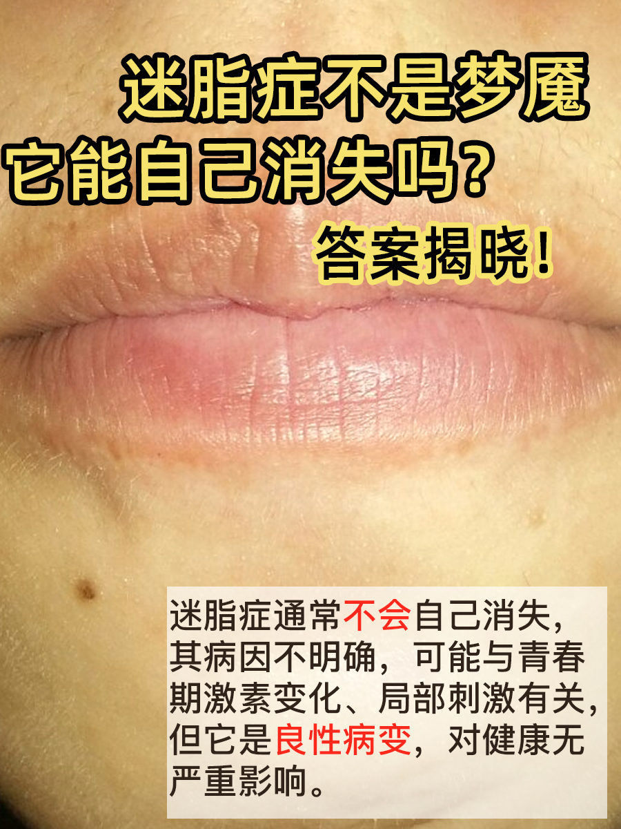 迷脂症不是梦魇,它能自己消失吗?答案揭晓!