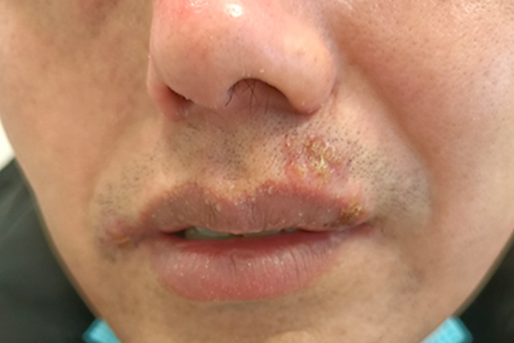 唇疱疹上唇水疱糜烂结黄痂图