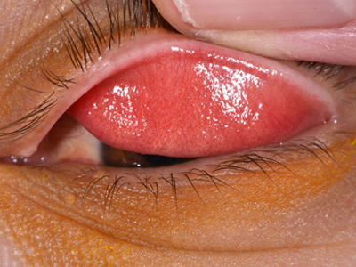 特应性角结膜炎可导致患者眼睑内有湿疹样的皮肤变化,眼皮内布满米粒