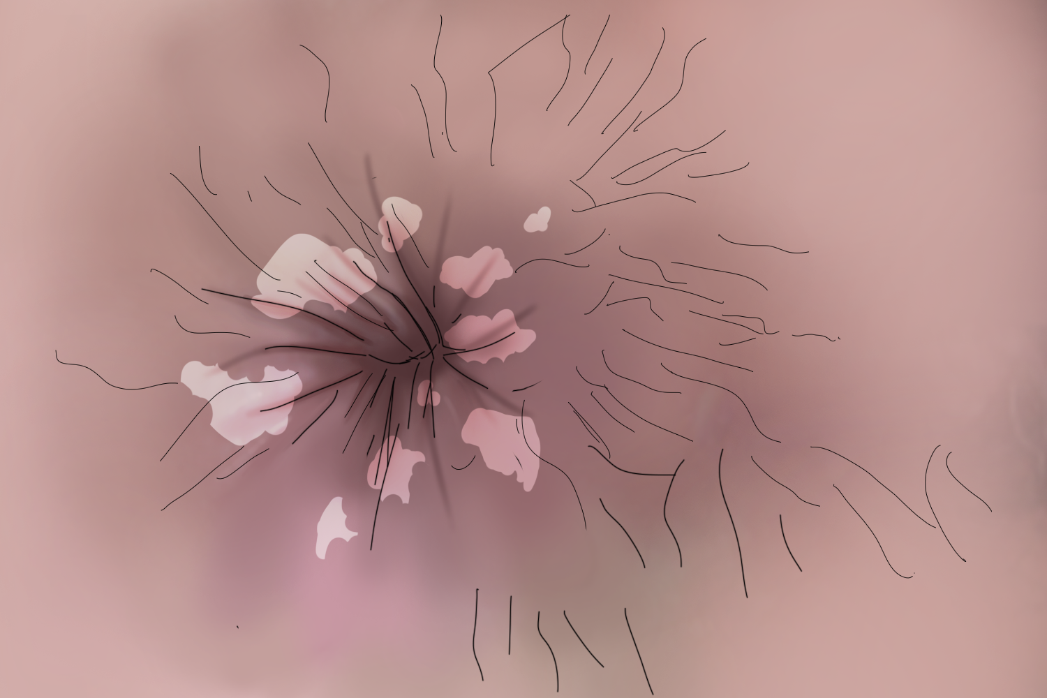 肛门白癜风图 肛门白癜风图