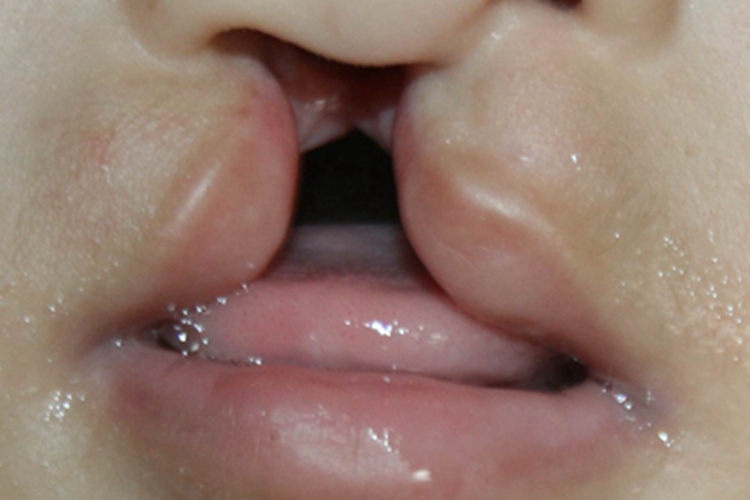 Ⅲ度唇裂嘴唇症状图 Ⅲ度唇裂嘴唇症状图