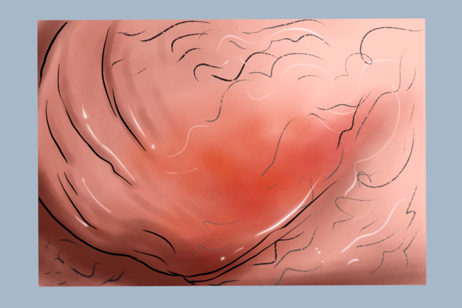 附睾结核阴囊包块图 附睾结核阴囊包块图