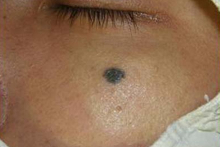 发育不良痣面部痣图