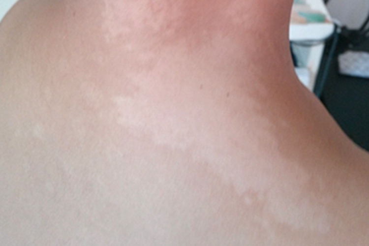 白色糠疹肩颈部出现白斑图