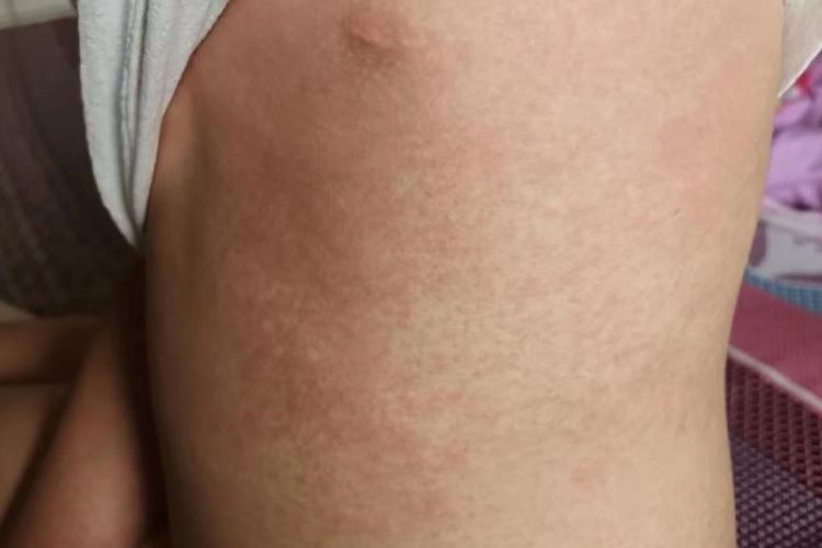 幼儿猩红热型药疹图