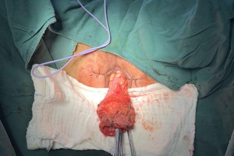 肛周息肉样增生脱出肛门图 肛周息肉样增生脱出肛门图