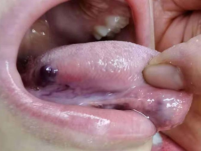 海绵状血管瘤舌头上长了个紫黑色肿物图