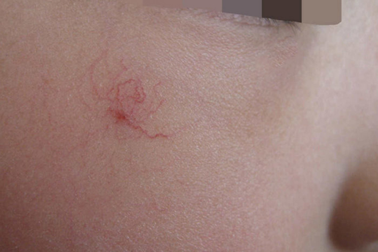 蜘蛛痣:由皮肤小动脉末端分支性扩张所形成的血管痣,状似蜘蛛,多发生