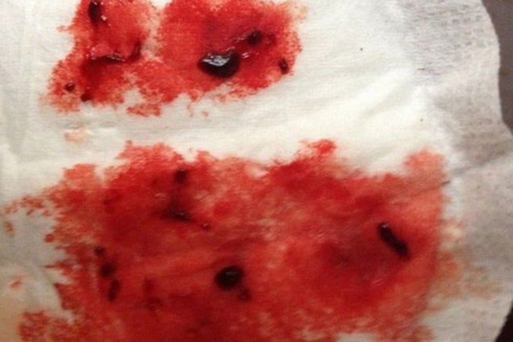 血样脓性排液图