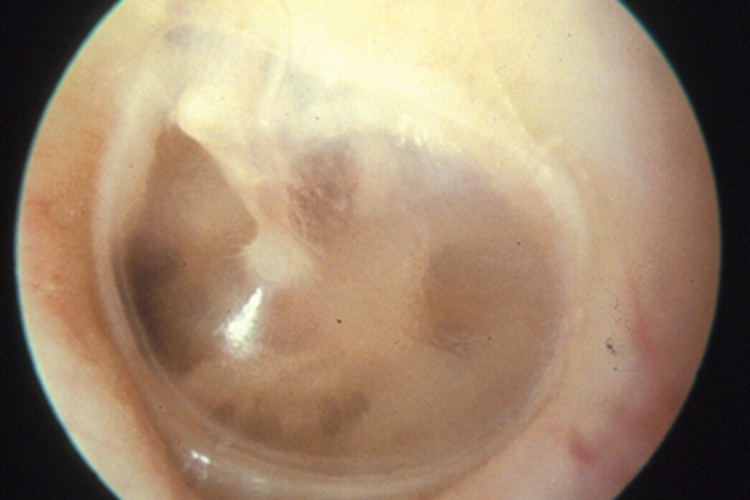 急性中耳炎耳部水肿图 急性中耳炎耳部水肿图