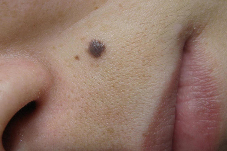 交界痣图 交界痣图