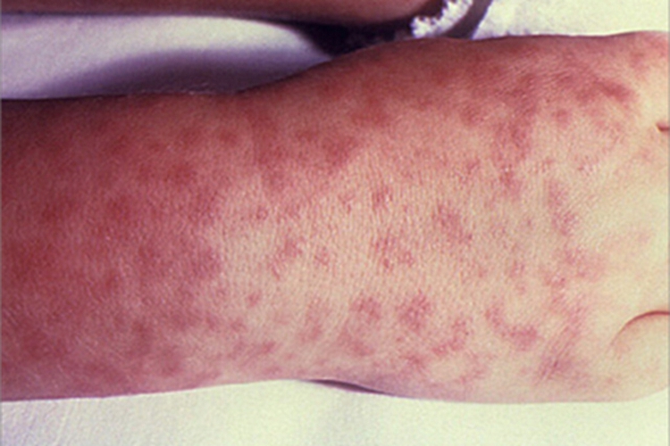 登革热手背丘疹图 登革热手背丘疹图