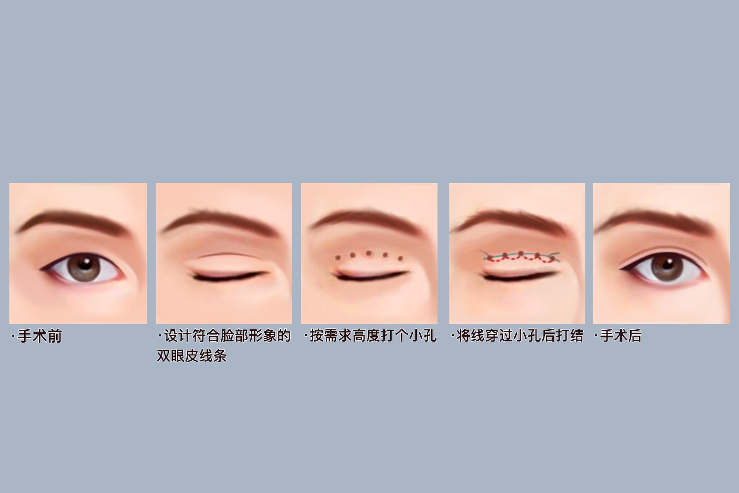双眼皮手术埋线法图 双眼皮手术埋线法图