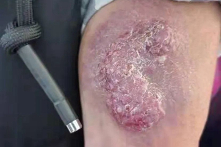 Merkel细胞癌胳膊红肿图