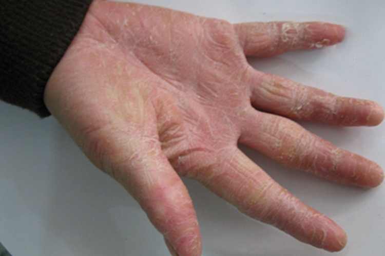 弥漫性掌跖角皮症手部皮肤增厚图 弥漫性掌跖角皮症手部皮肤增厚图