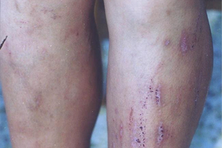 冬季瘙痒症小腿有血印图 冬季瘙痒症小腿有血印图