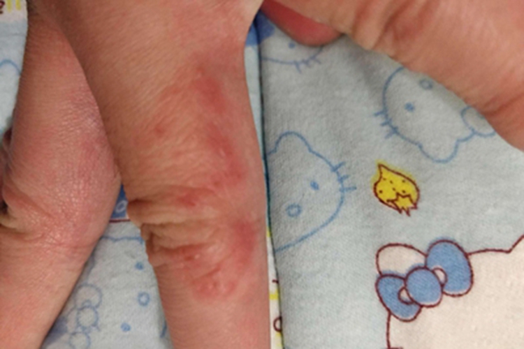 体虱病小红疙瘩图 体虱病小红疙瘩图