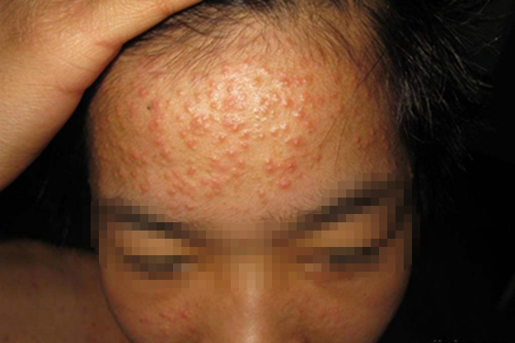 马拉色菌毛囊炎丘疹图