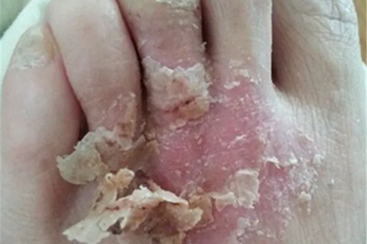 糜烂型足癣脚背症状图