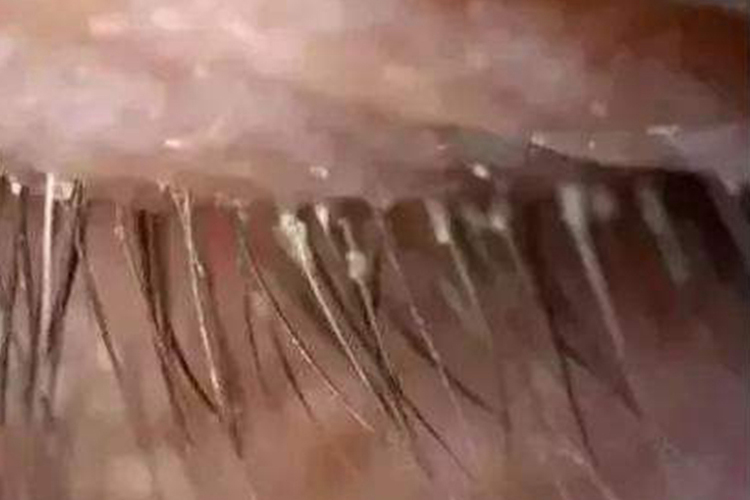 眼睫毛根部蠕形螨图