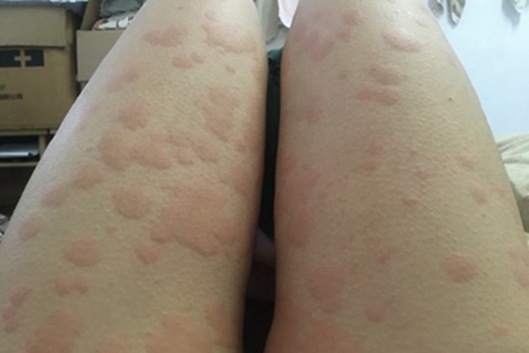 荨麻疹大腿风团图 荨麻疹大腿风团图