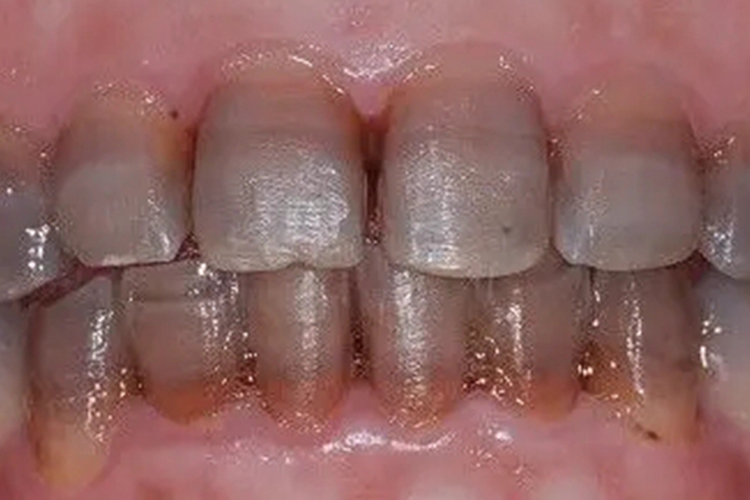 极重度四环素着色图 极重度四环素着色图