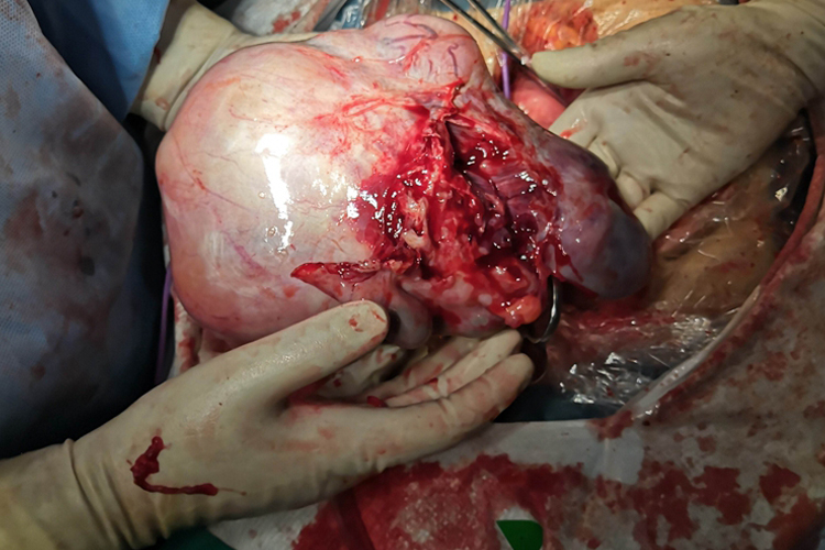 卵巢恶性肿瘤图