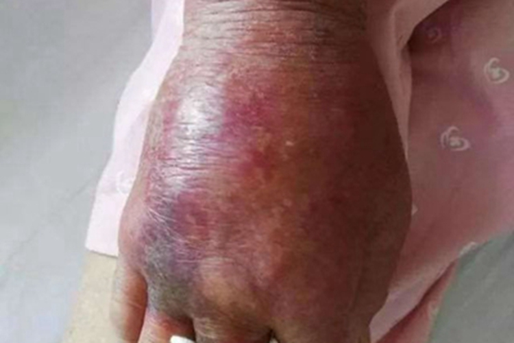 坏死性筋膜炎红肿图