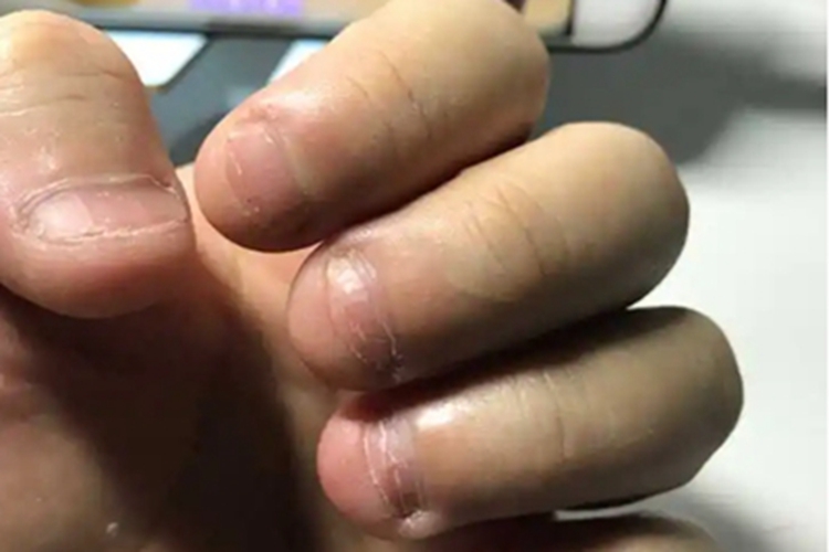 咬甲癖手指甲表面粗糙图