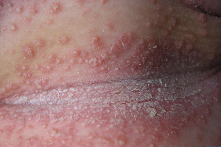 丘疹红斑上附鳞屑图 丘疹红斑上附鳞屑图