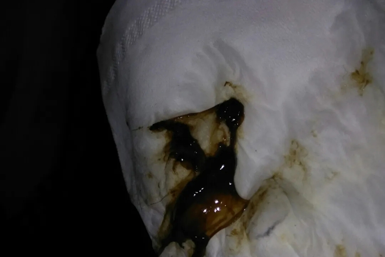 子宫内膜炎黑褐色分泌物图