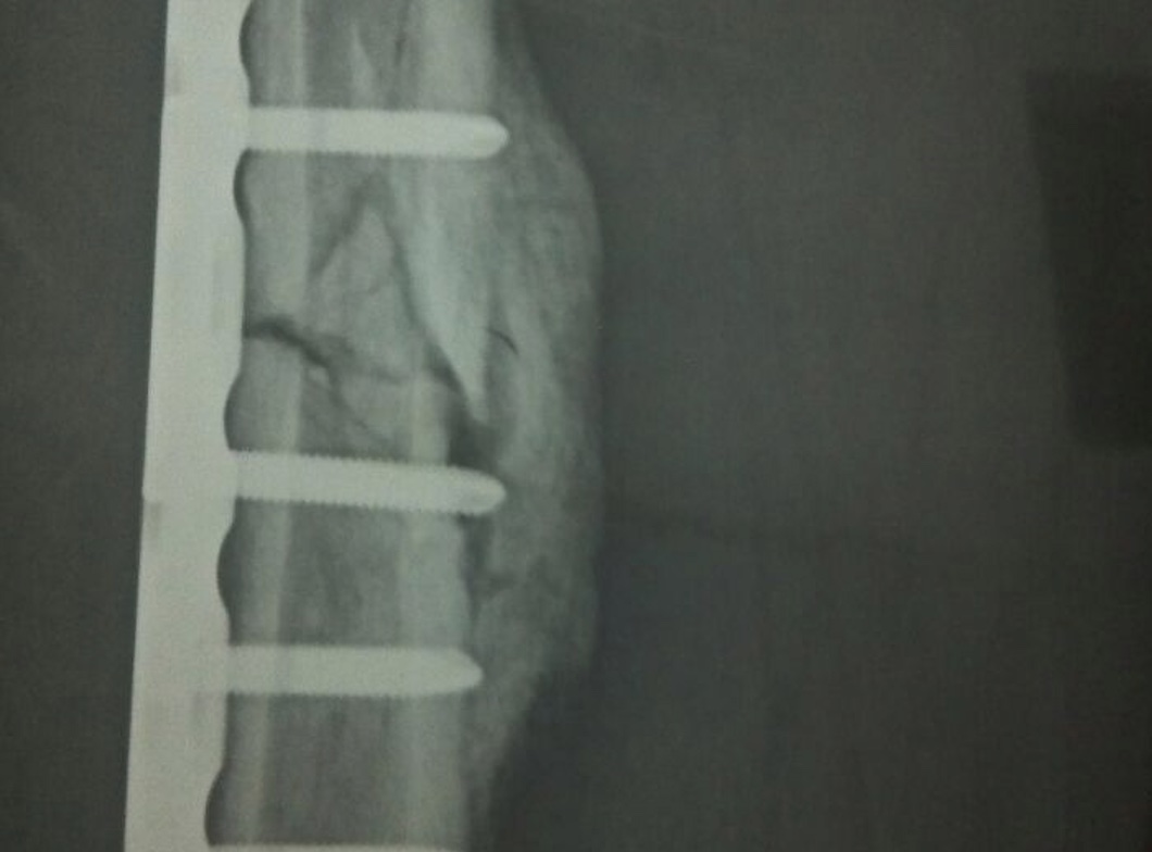 小腿骨折骨痂图 小腿骨折骨痂图