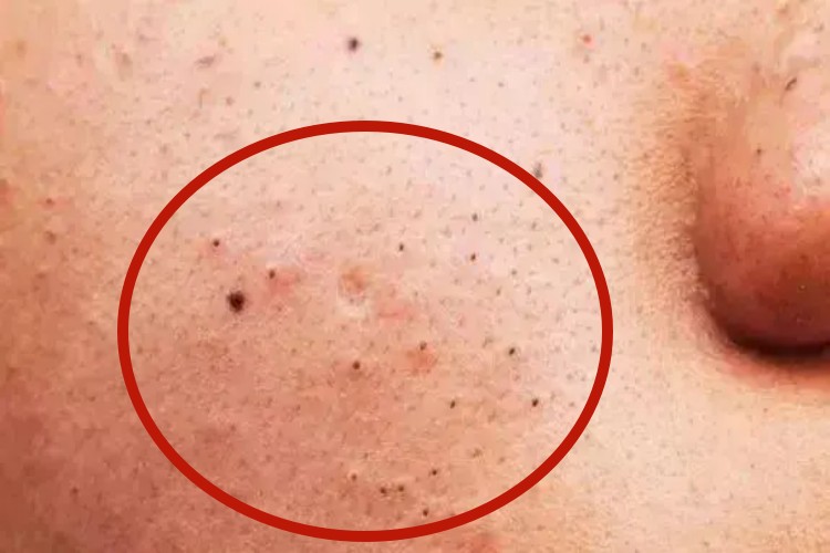 毛孔粗大面部黑点图