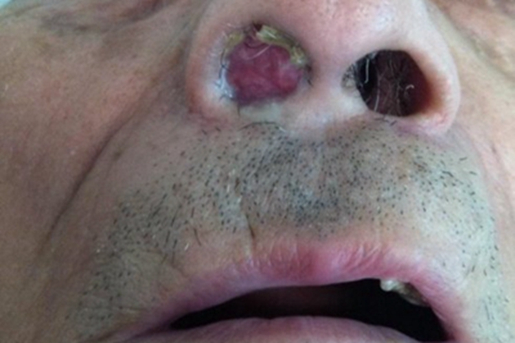 鼻孢子菌病鼻腔堵塞有红色肿块图