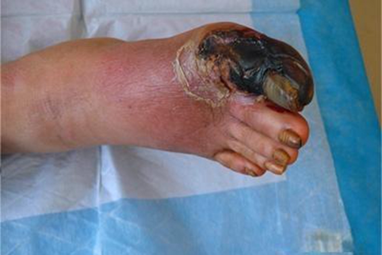 炭疽病脚部症状图