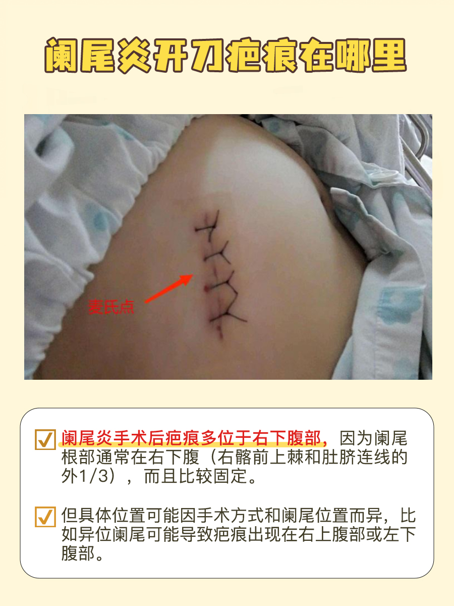 阑尾炎手术后疤痕位置指南：究竟在哪里