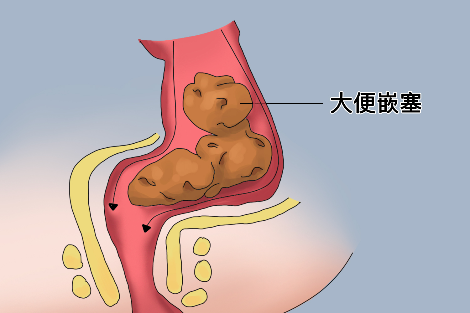 婴儿肛门狭窄大便嵌塞图