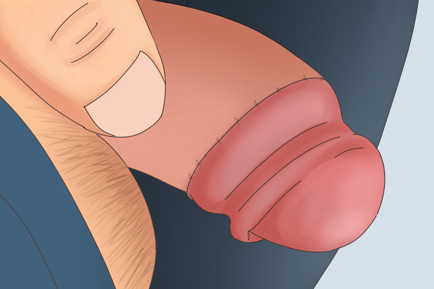 包皮环切术后轻微水肿图