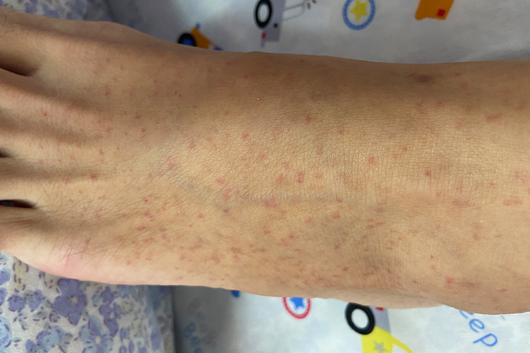 过敏性紫癜皮疹图