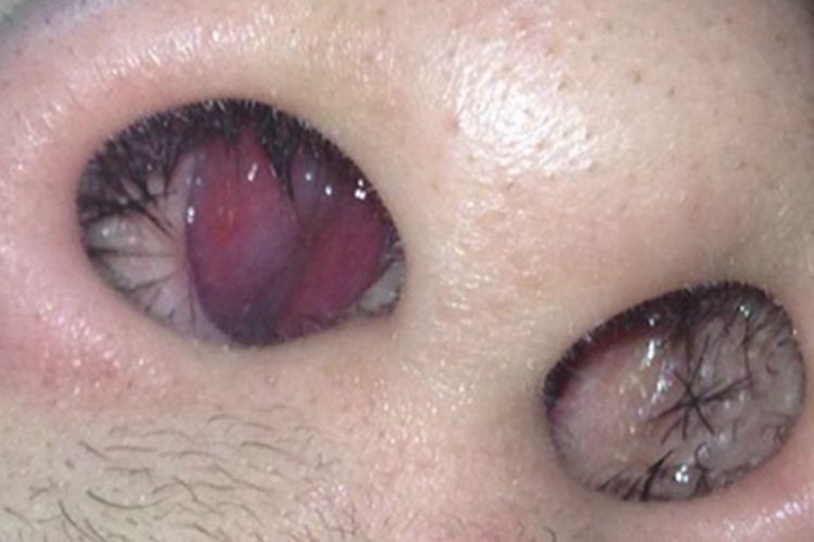 慢性化脓性鼻窦炎充血图