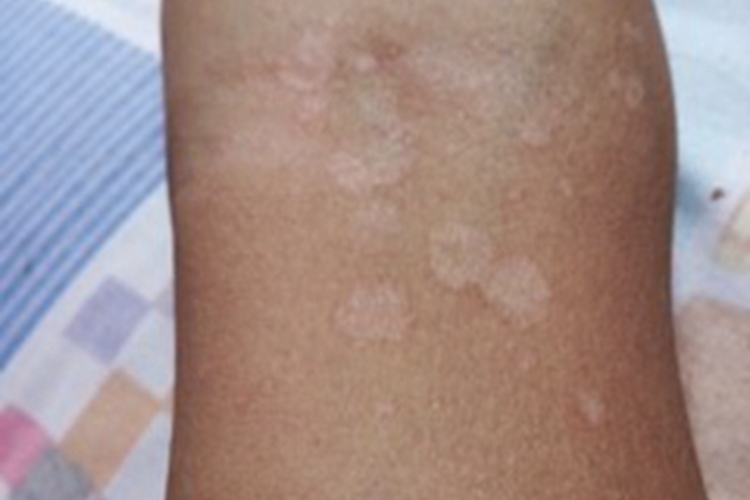 花斑糠疹胳膊上有白斑图