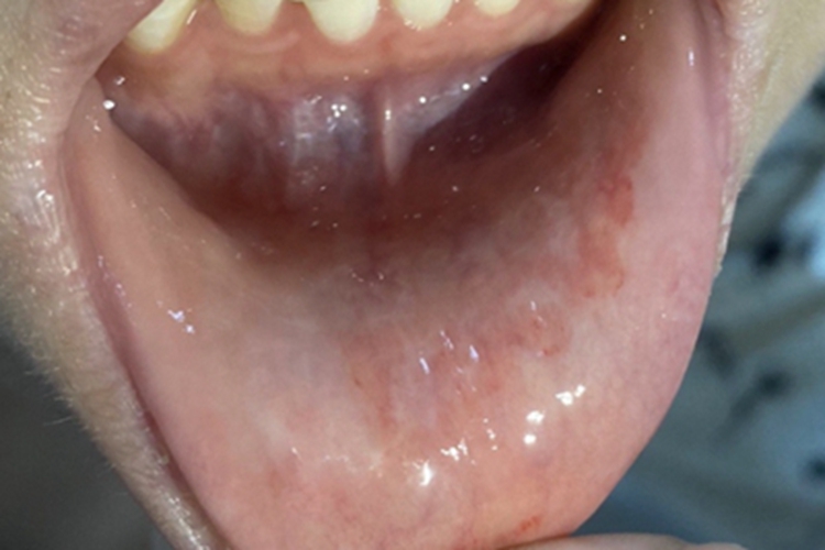 接触性唇炎唇内侧血丝图